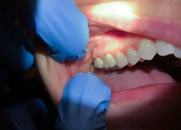 Best Emergency Dental Care for Sports Injuries in Hayneville, AL